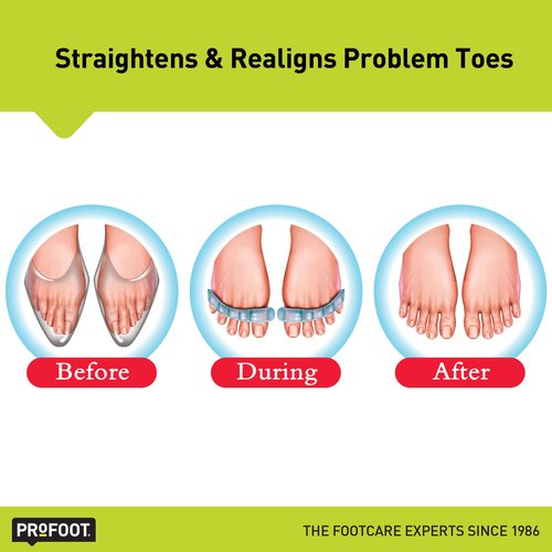 PROFOOT Flex-tastic Toe Spacers, Gel Toe Separators for Foot Pain, Bunions, Overlapping & Hammer Toes, Helps Restore Alignment & Circulation, Fits All, 1 Pair