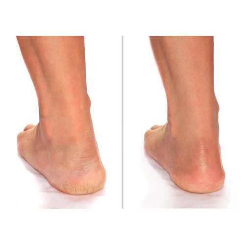 Advanced Clinicals Cracked Heel Foot Cream Moisturizer Skin Care Lotion For Feet W/Shea Butter, Moisturizing Foot/Hand Lotion Helps Heal Cracked Skin, Rough Spots, Calluses, & Dry Skin, 2-Pack