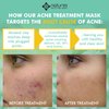 Natural Clear Acne Treatment Mask-Works Fast To Clear Zits, Spots, Blemishes, Whiteheads, and Blackheads. Immediately Gets To The Root Cause Of Breakouts.