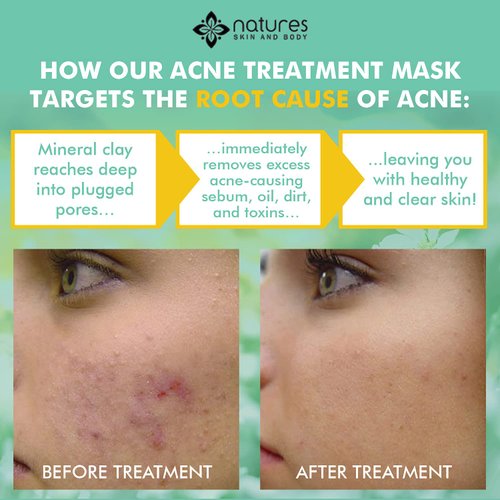 Natural Clear Acne Treatment Mask-Works Fast To Clear Zits, Spots, Blemishes, Whiteheads, and Blackheads. Immediately Gets To The Root Cause Of Breakouts.