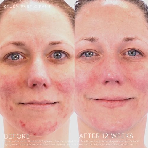 RODAN + FIELDS UNBLEMISH Acne Face Wash | 125 ml | Salicylic Acid Exfoliator for Blemish Prone Skin | Controls Oil, Soothes Skin, Gentle on Skin Types