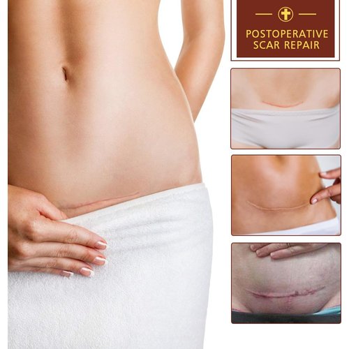 3 Pack Scar Removal Cream - TCM Scar Cream for Surgical Scars, Acne Skin Care Cream, Acne Treatment Cream for Scars, Burns, Stretch Marks, Acne Spots