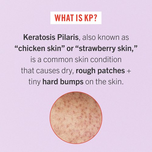 First Aid Beauty - Smooth Operators Trio: KP Bump Eraser Body Scrub, 8 oz, Smoothing Lotion, 6oz, and Ingrown Hair Pads, 28 Pads, Deep Moisture Exfoliating Skin Treatment Set with BHA & AHA, 3ct