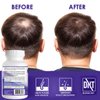 Propidren by HairGenics - DHT Blocker & Hair Growth Supplement to Combat Hair Loss, Stimulate Follicles, and Promote Regrowth. Proprietary Hair Treatment.