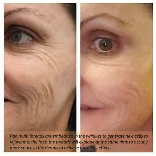 Oldream Pdo Multi Threads for Face Lift, L-Type, 23G38MM, 20pcs