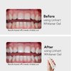 LINHART Teeth Whitening Kit with LED Light - Tooth Whitener Gel, Professional Dental Whitening Gel Syringes with 35% Carbamide Peroxide and 16-Led Whitening Light - No Sensitivity, Whitens Teeth