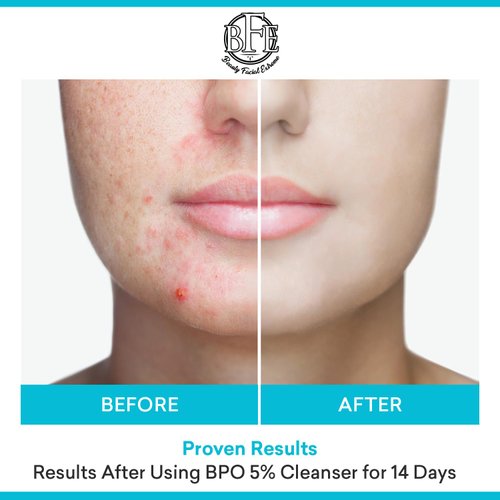 Acne Face wash Treatment with Benzoyl Peroxide 5% - Fight Acne Blemishes on Contact for Cystic Breakouts, Oily Skin, Clogged Pores, Blackhead, Whitehead & Pimples. Achieve Clear Skin.